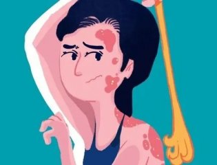 探索牛皮癣治疗的科学与希望